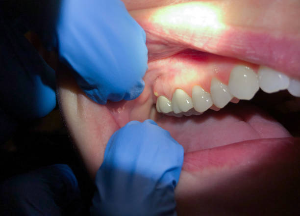 Best Emergency Denture Repair in Finneytown, OH